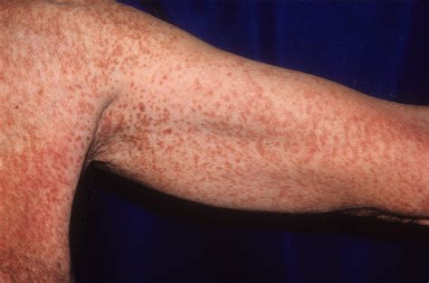 Mastocytosis Systemic Rash