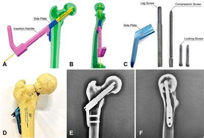 Frontiers Biomechanical And Clinical Evaluation Of Interlocking Hip