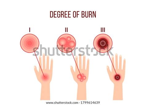 Vektor Stok Infographics Different Degrees Burn Medical Poster Tanpa