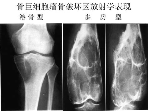 骨巨细胞瘤超声声像图 骨囊肿和骨巨细胞 指骨骨巨细胞 第15页 大山谷图库