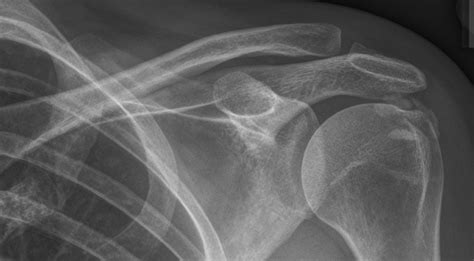 Rotator Cuff Calcific Tendinopathy