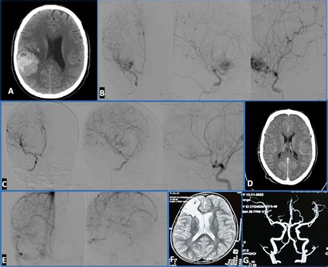 A Brain NCCT Nonenhanced Computed Tomography Of A 6 Years Old Male