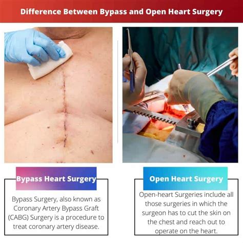 Bypass Vs Open Heart Surgery Difference And Comparison