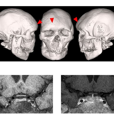 Case 1 A Three Dimensional Reconstructed Computed Tomography Image Download Scientific