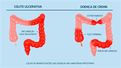 Doenças Inflamatórias Intestinais E Câncer De Colorretal