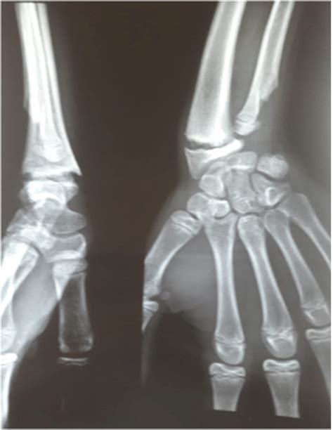 X-ray of the wrist showing the pseudarthrosis of inferior radial growth ...