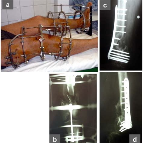 PDF The Use Of Twin Ring Ilizarov External Fixator Constructs