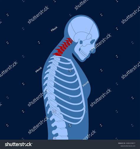 Diagram Deformation Cervical Vertebrae Neck Spasm Stock Vector Royalty