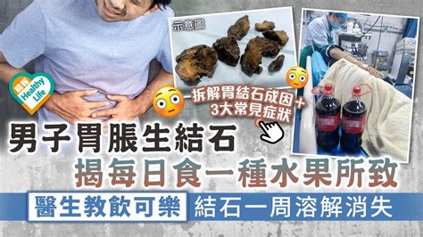 食用安全︳男子日食一種水果致胃脹生結石 醫生教飲可樂結石一周溶解消失︳附胃結石常見症狀 晴報 健康 飲食與運動 D221025