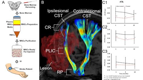 Injecting Bone Marrow Cells Helps Heal The Brain After Stroke