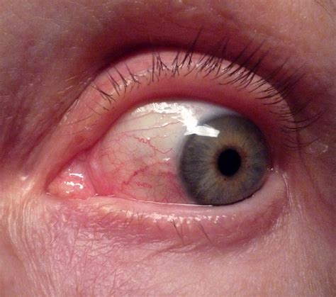 Conjunctivitis: Allergic, infectious or chemical? www.advancedoptometry.net