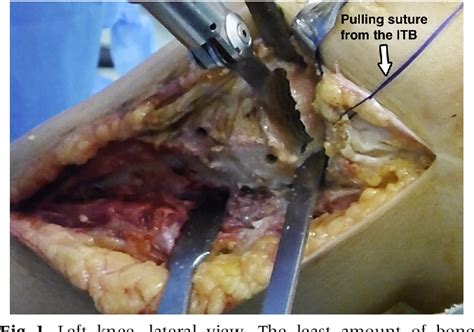 Figure From Fresh Osteochondral And Meniscus Allografting For Post