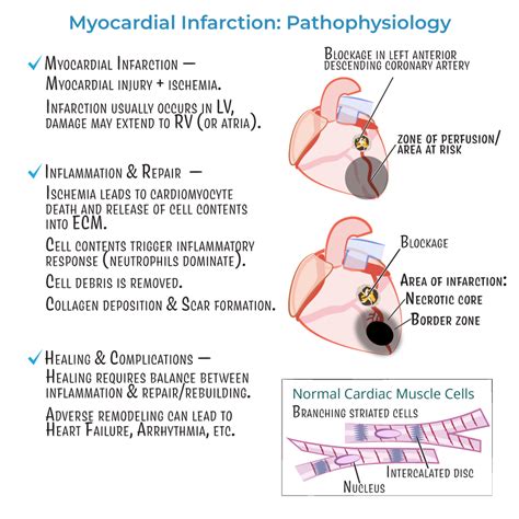 Myocardial Infarction Histology Timeline