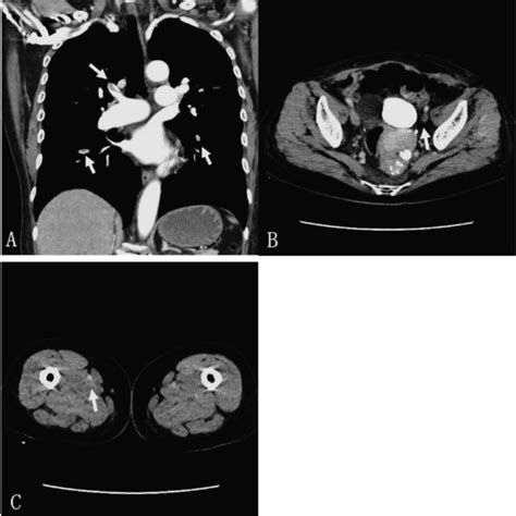 Contrast Enhanced Computed Tomography Findings At Admission A