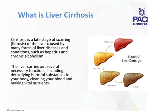 PPT Liver Cirrhosis Treatment In Hyderabad PowerPoint Presentation