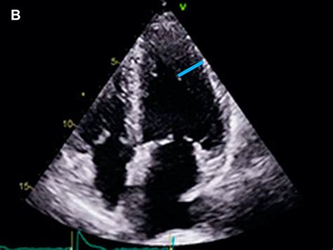 Cuantificaci N Del Espesor Parietal Mediante Ecocardiograf A Una