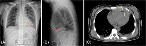 A And B Chest Radiograph Revealed High‐density Shadows In Cardiac