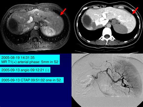 Gi Radiology Case 1 陳x貞 45 Year Old Female Ppt Download