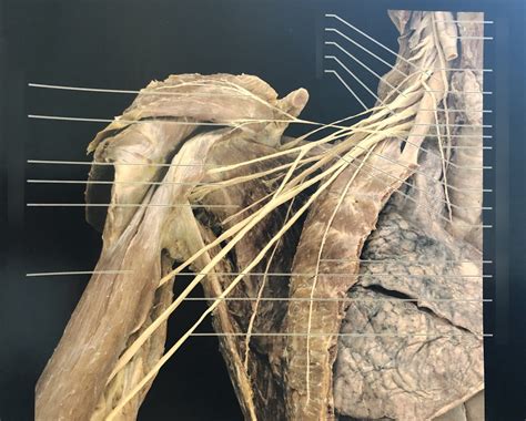 Brachial Plexus Of Cadaver Diagram Quizlet Hot Sex Picture