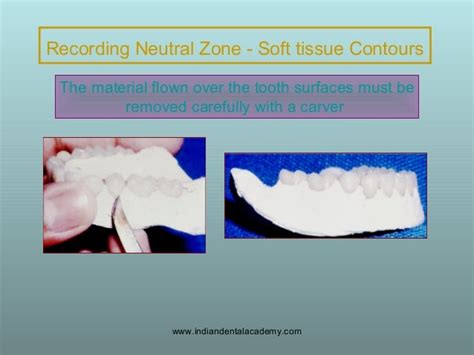 Concept Of Neutral Zone Dental Seminars