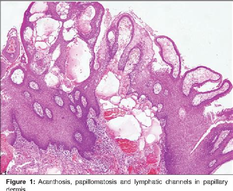 Lymphangioma Histology