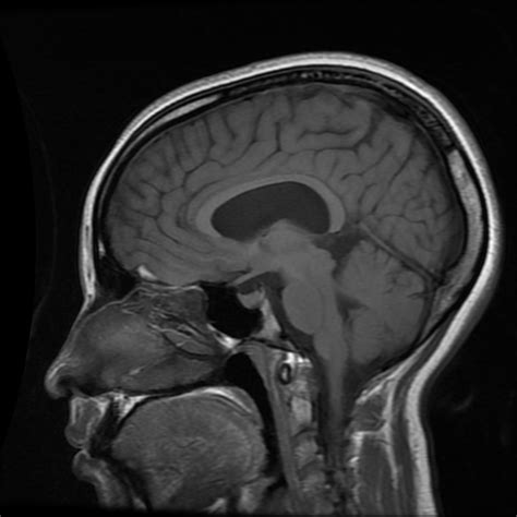 Cavum Septum Pellucidum Et Vergae Cyst Image Radiopaedia Org