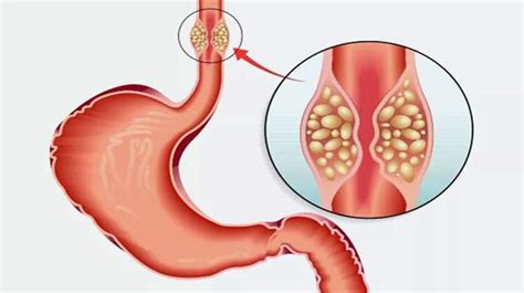 Esophageal Cancer Treatment Cost In India