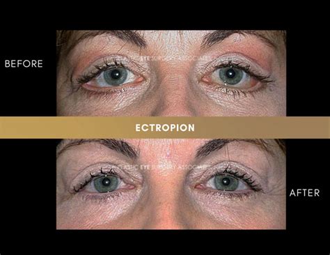 Ectropion Entropion Photos - Plastic Eye Surgery Associates