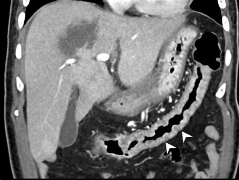 Amebic Colitis In A 62 Year Old Man With Type I Amebic Liver Abscess Download Scientific