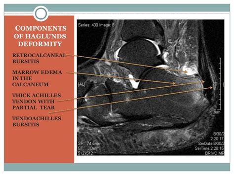 Haglunds Deformity