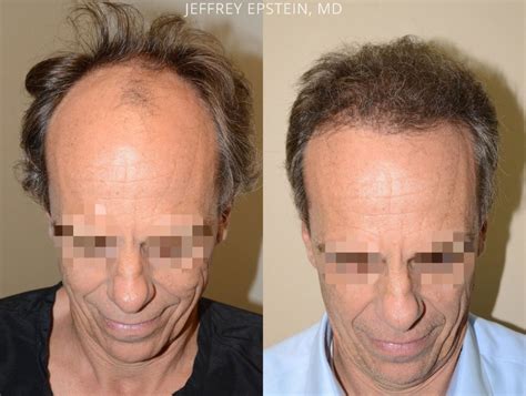 Hair Transplants For Men Photos Miami Fl Patient57664