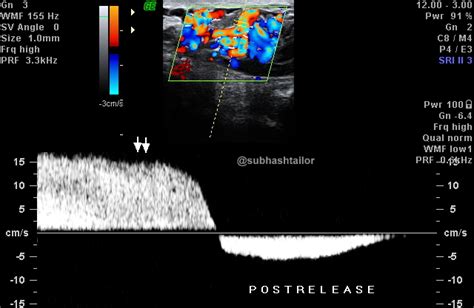 Sono Digest Testicular Doppler Varicoceles Color And Spectral Doppler