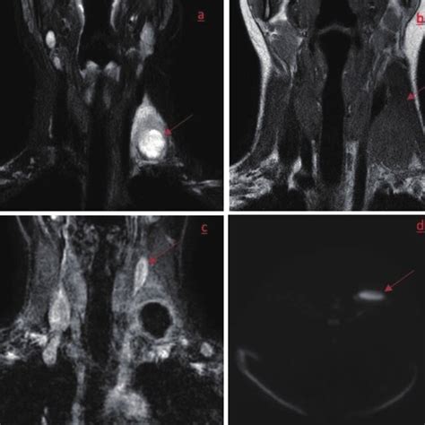 A B Coronal T2 Weighted Dixon Fat Suppressed Image And A Coronal T1w