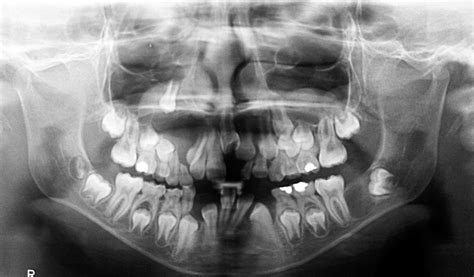 Keratocystic Odontogenic Tumors Clinical And Molecular Features