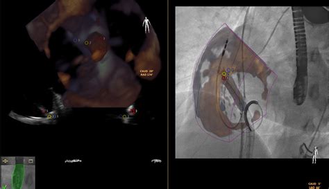 Fusion Of 3 Dimensional Echocardiography And Fluoroscopy Using