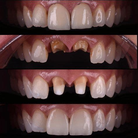 Replacement Of Misfit Metal Ceramic Crowns With Ips E Max Crowns Fiber