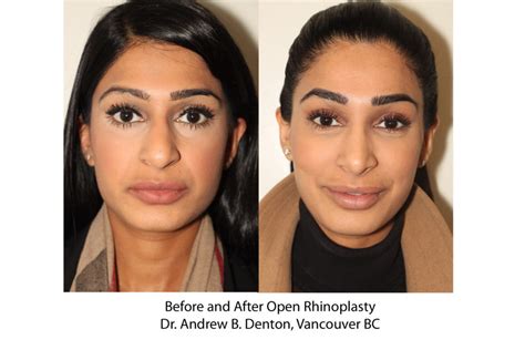 Before And After Open Rhinoplasty Dr Andrew B Denton Vancouver BC