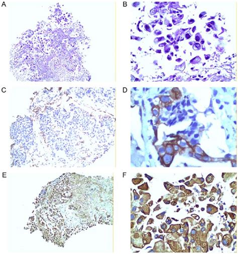 Ring Finger Protein 180 Is Expressed In NSCLC Tissue Samples Negative