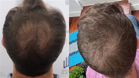 Before and After Hair Transplant : r/cosmeticsurgery