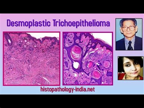 Pathology Of Desmoplastic Trichoepithelioma By Dr Sampurna Roy MD