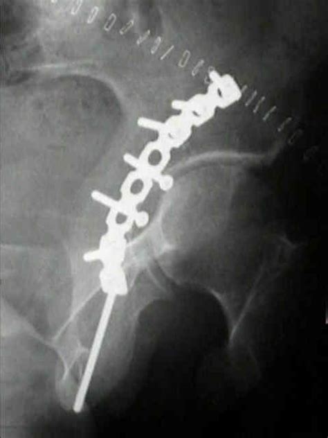 Posterior Acetabular Wall Fractures Wheeless Textbook Of 60 Off