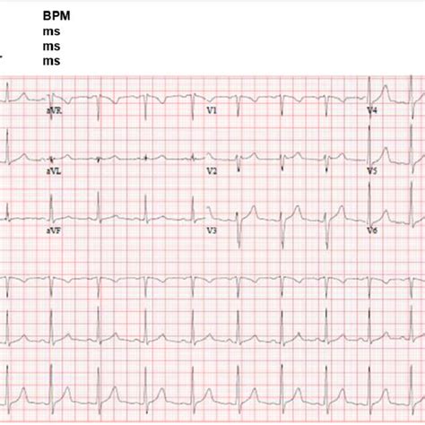 Twelve Lead Electrocardiogram Of The Patient At Presentation The