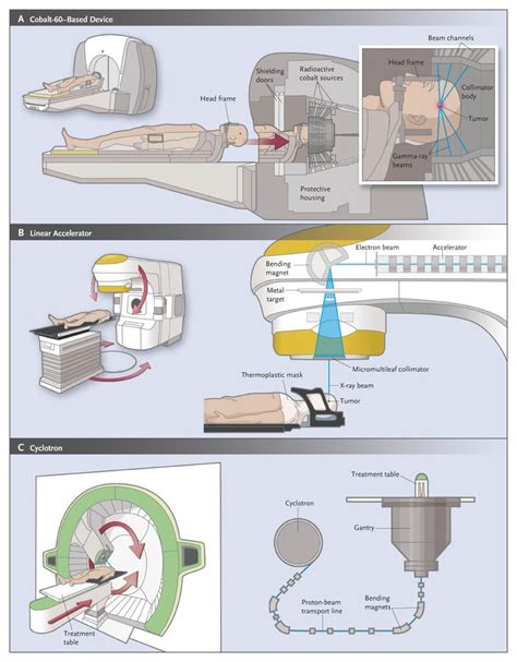 Stereotactic Radiosurgery For The Management Of Brain Metastases NEJM