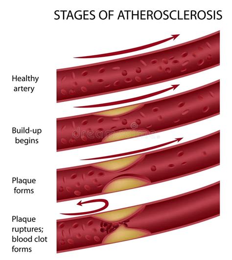 Atherosclerosis Stock Vector Illustration Of Diagram