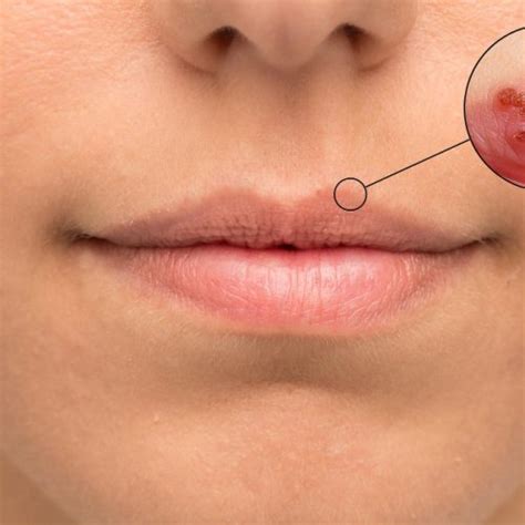 Lippenherpes Behandlung Diagnose Direkt Vom Online Hautarzt