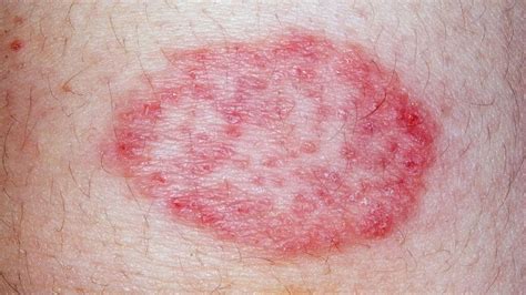 Early Squamous Cell Skin Cancer Signs