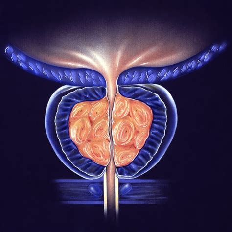 TRUS Ultraschalluntersuchung der Prostata zur Früherkennung von