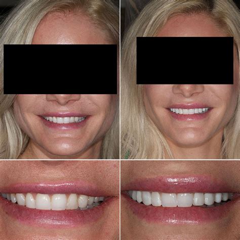 Before and After - Dr. Dayna Cassandra Cosmetic Dentistry | Paramus NJ