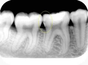 Interpretacion Radiograficas De La Caries Dental