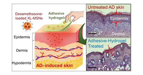 Adhesive Composite Hydrogel Patch For Sustained Transdermal Drug